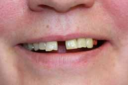 диастема зубов