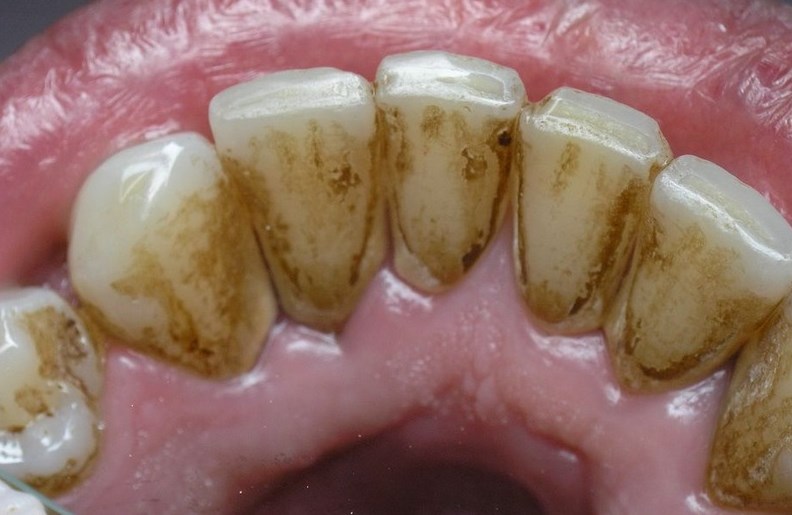 бактериальный налет на зубах