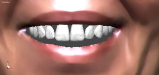 коррекция формы зубов