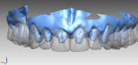 3D-моделирование формы зубов 3D-моделирование формы зубов
