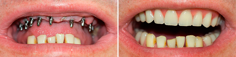 implantaciya-zubov-1-den-do-posle.jpg